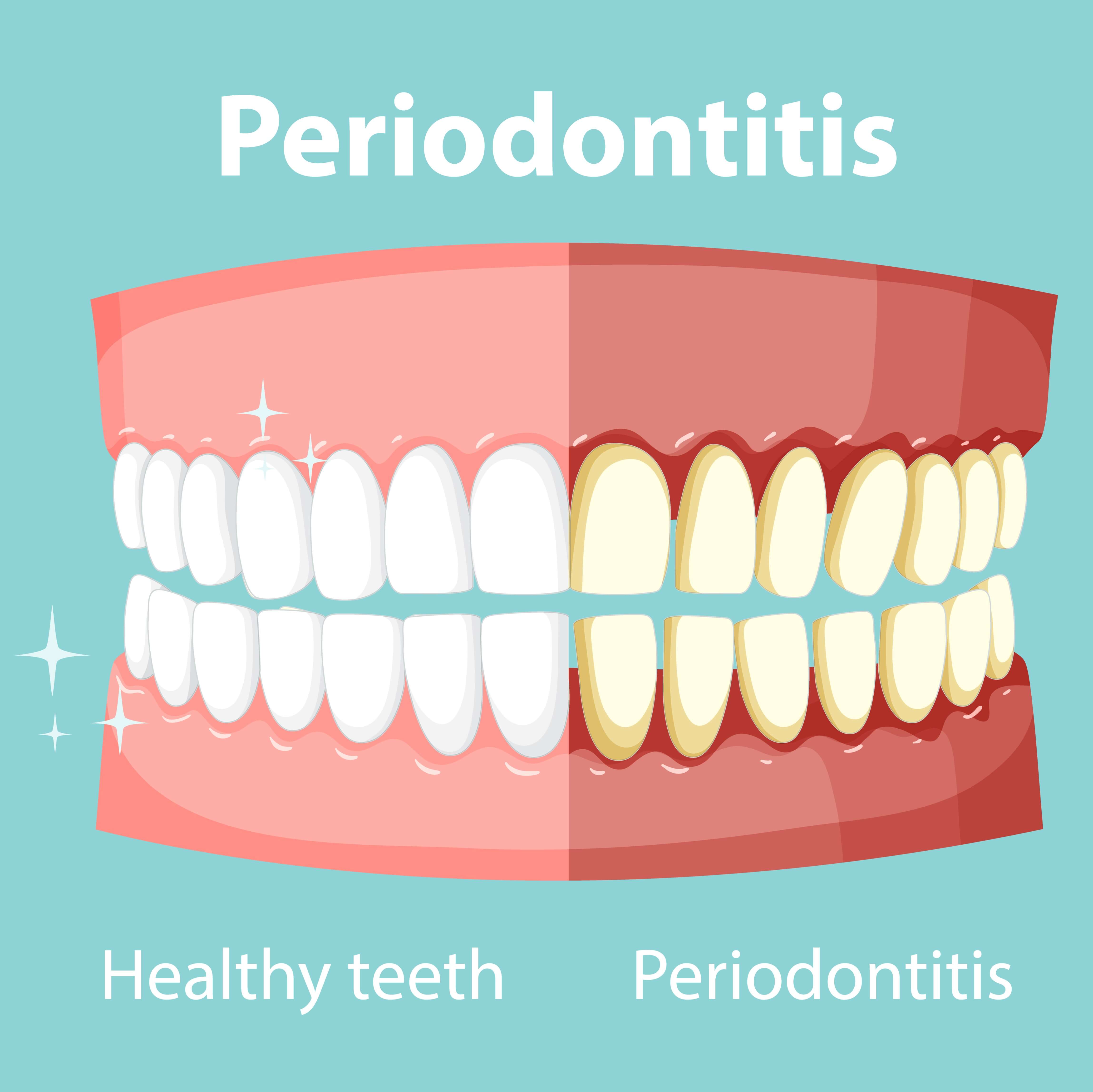 겅강한 치아와 치주질환 치아 사진
