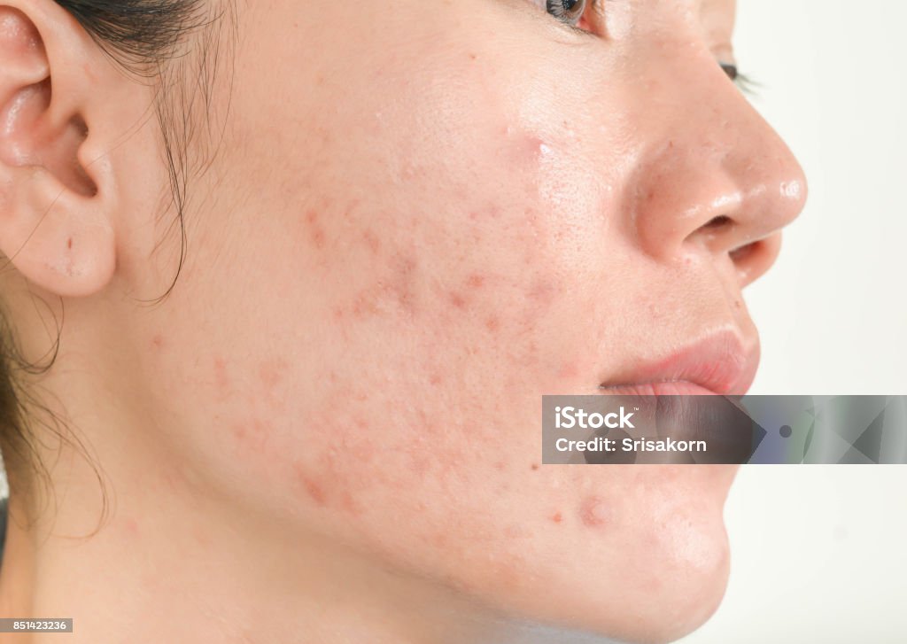 여드름은 관리를 정말 잘 해줘야 한다