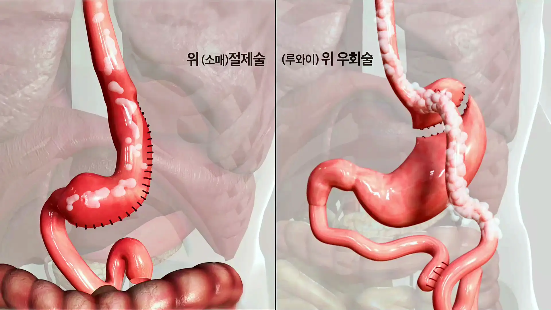 KBS 생로병사의 비밀 827회 최후의 다이어트 고도비만 위절제 수술, 위우회술 수술 차이점과 의료보험 대상 조건