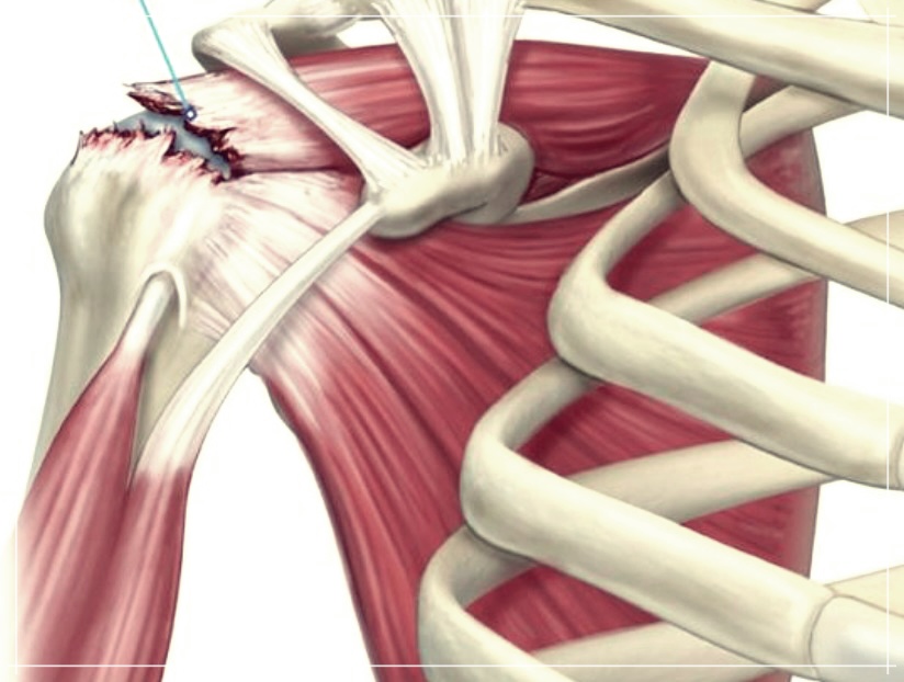 골종양에 대한 깊은 이해: 증상, 양성골종양 그리고 치료병원