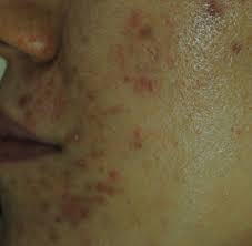 지루성 피부염 완치하려면