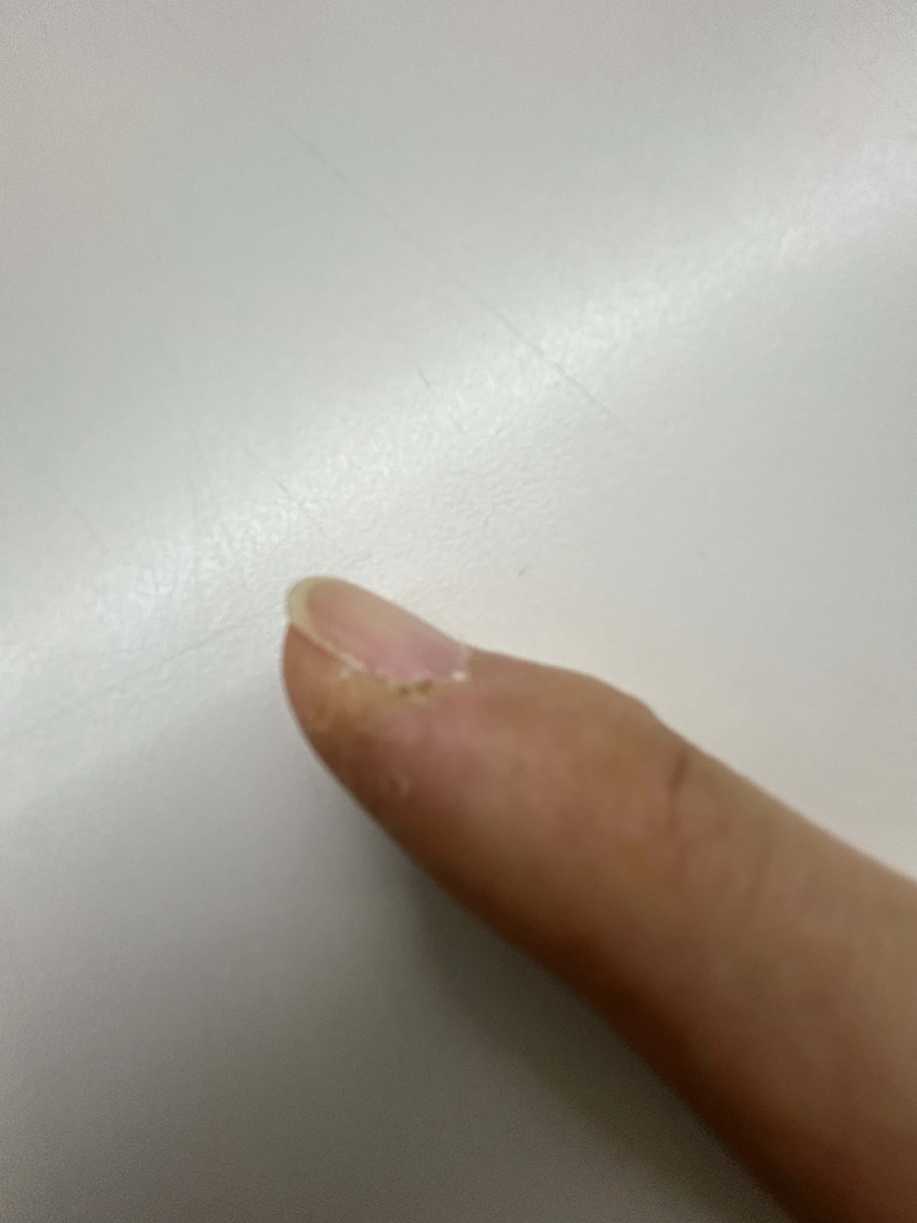 손톱 옆 거스러미 뜯지 마세요