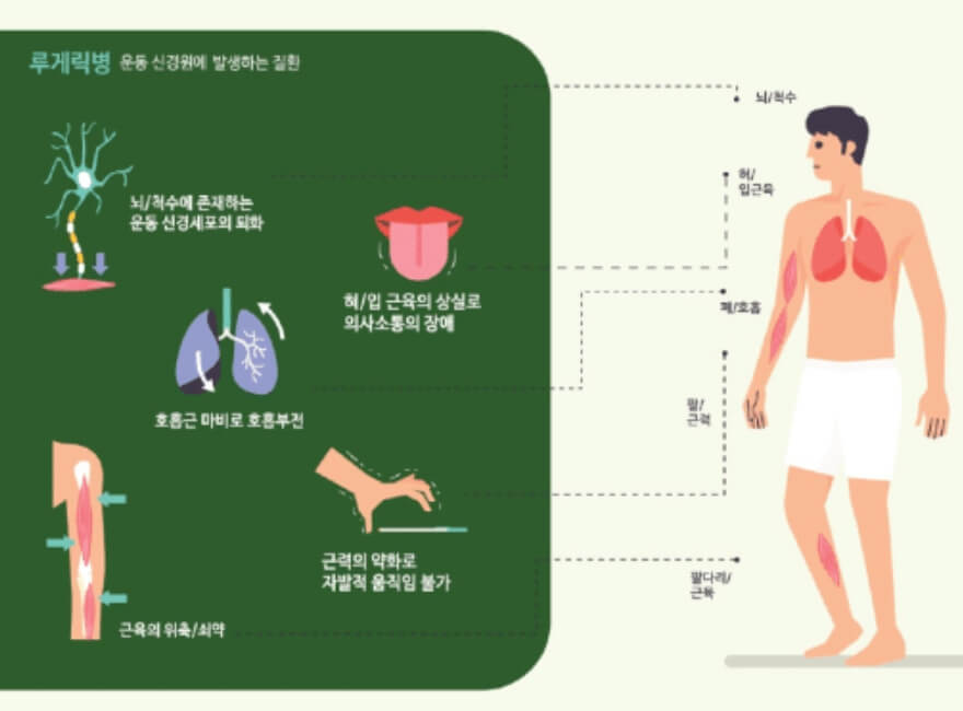 루게릭병