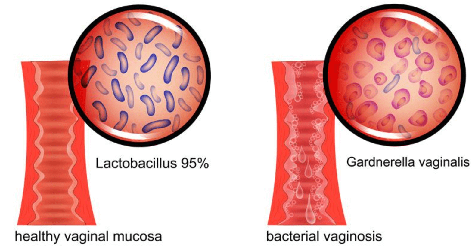 가드넬라 질염 원인