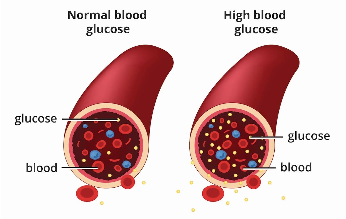 diabetes