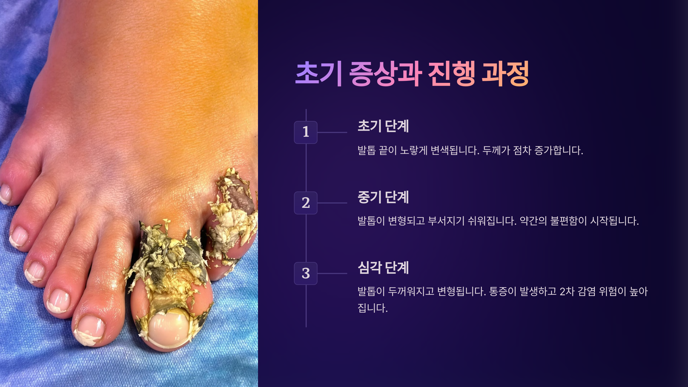 발톱무좀 없애는 방법