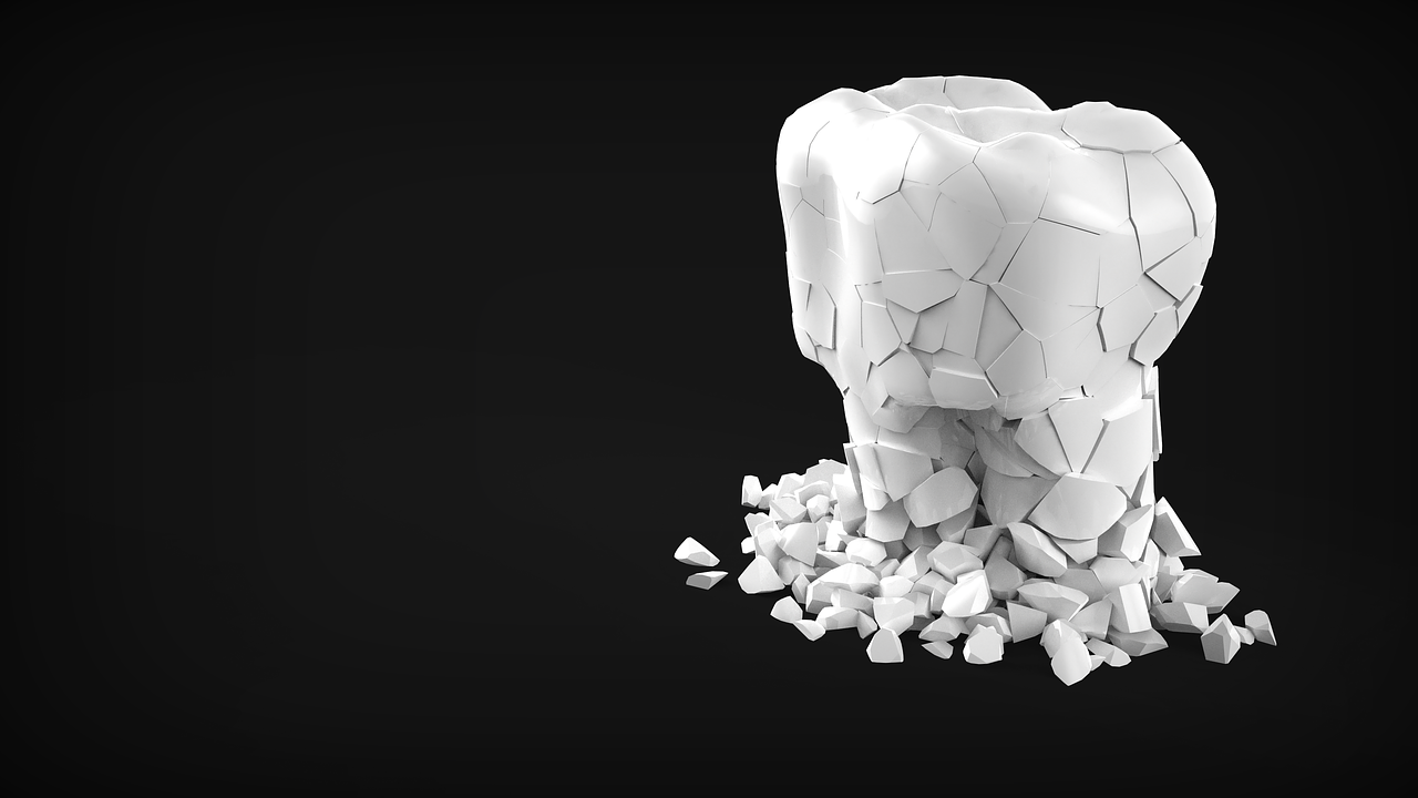 임플란트 시술과정 총정리