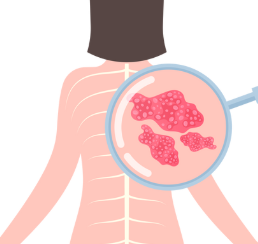 대상포진 예방접종 가격 무료 대상