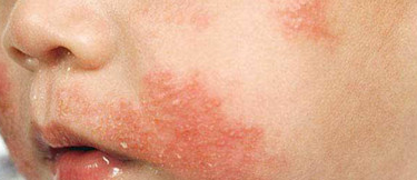 아토피 치료법2