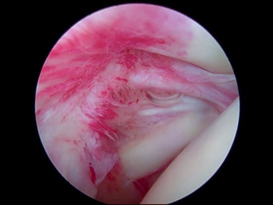 유착성 관절낭염(오십견)