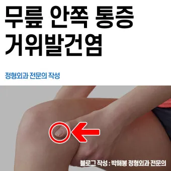 거위발 건염 원인과 증상 무릎 안쪽 통증 치료법 정리_19