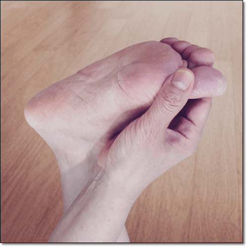 소와각질융해증 원인 및 증상과 치료 관리