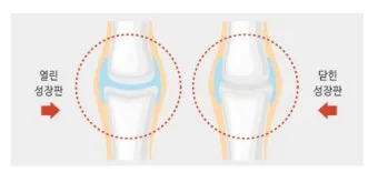 성장판 닫혀도 키 클 수 있는 방법과 성장 호르몬 시기_5