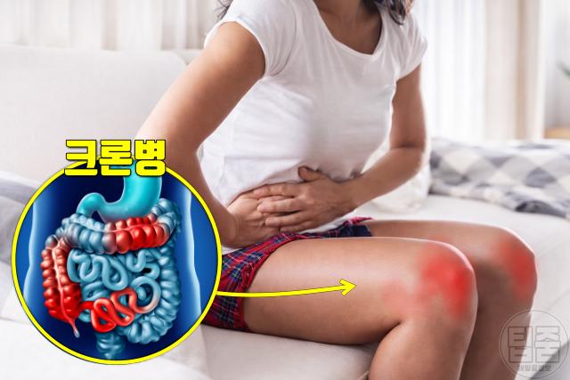 전신 관절통 원인 크론병 과민성대장증후군