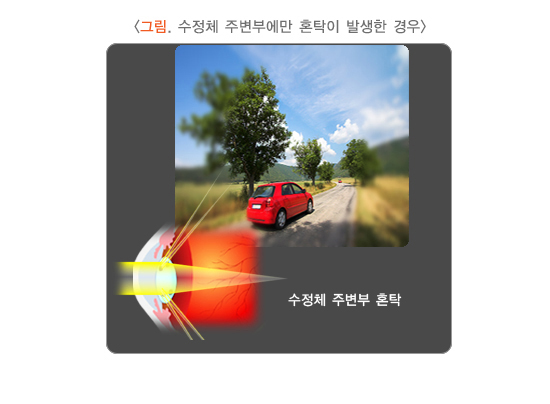 수정체 주변부에만 혼탁이 발생한 경우