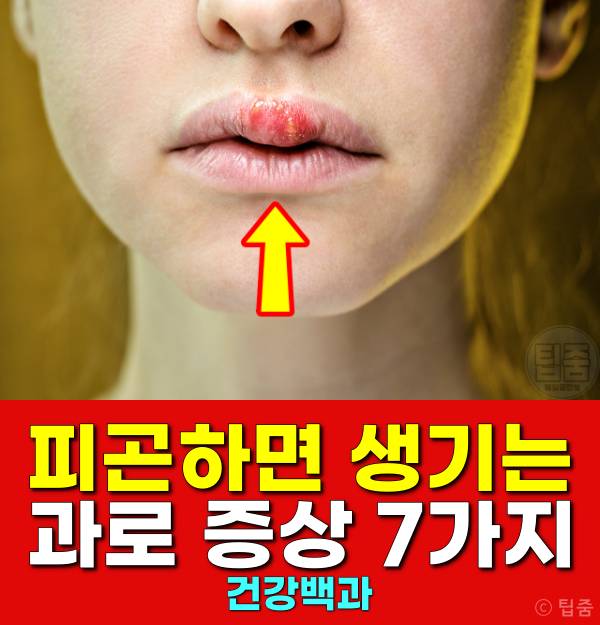과로증상 피곤하면 입술물집 혈뇨 쌍커풀 귀가멍멍 코피 코골이 두드러기