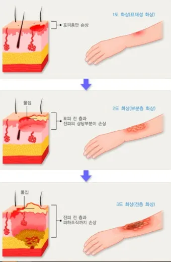 2도 화상 증상 자가치료 회복기간 응급처치법 정리_2