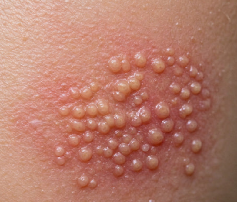 대상포진-걸린-피부