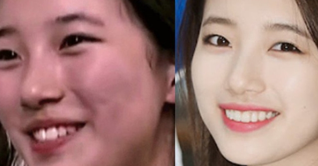 덧니-라미네이트