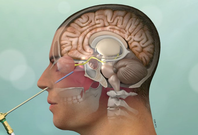 쿠싱증후군 치료