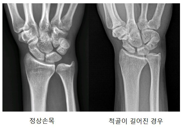 정상인 손목과 비정상인 손목의 엑스레이 뼈 비교 사진