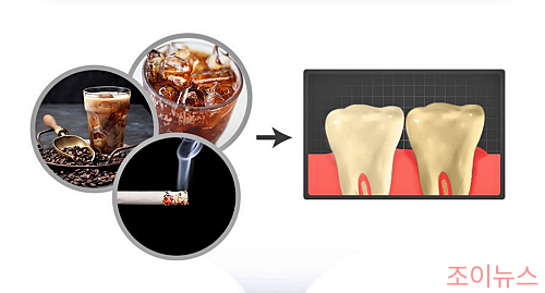 치아변색의 원인