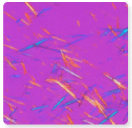 편광 현미경으로 관찰된 보라색 바탕에 뾰족한 요산결정들