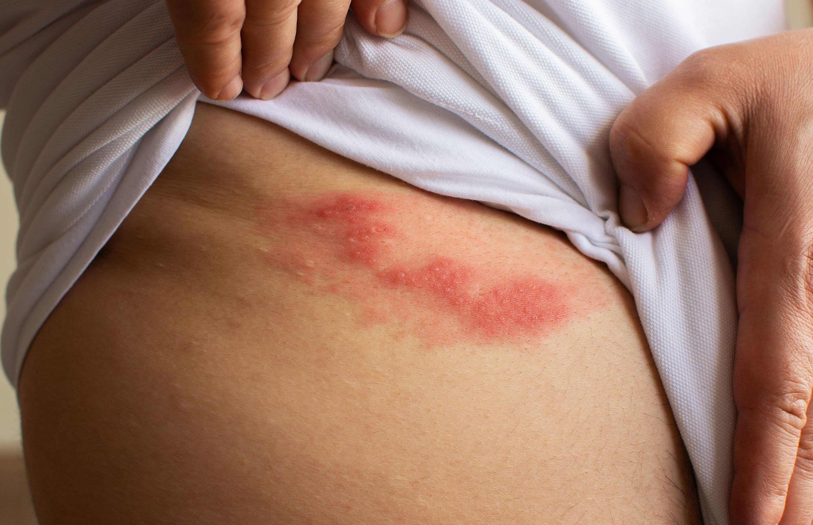 수포 없는 대상 포진: 증상, 원인, 진단 및 효과적인 치료 방법