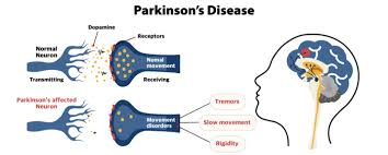 파킨슨병 장애등급 혜택