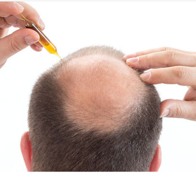 미녹시딜 부작용