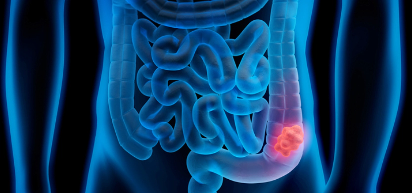 대장암-초기-증상-사진