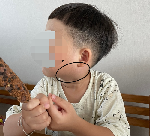 아이 턱이 붓는 이유, 혹시 이 질환때문인가요?
