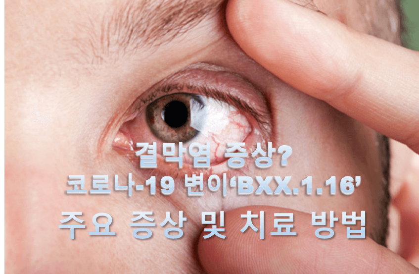결막염 증상? 코로나-19 변이 &#39;BXX.1.16&#39; 주요 증상 및 치료 방법