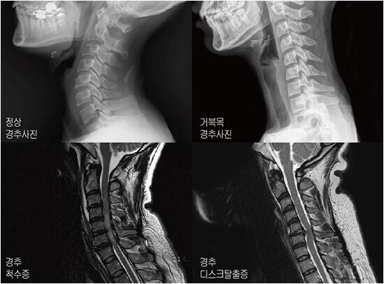 경추 모습에 따른 엑스레이 사진