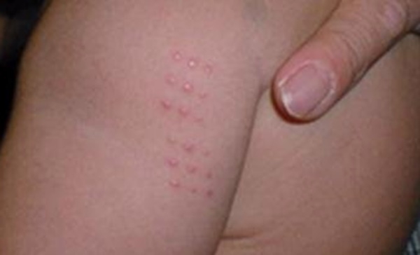 경피용 BCG 백신