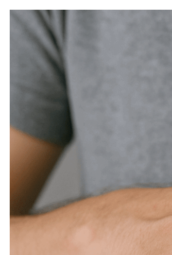 콜린성 두드러기