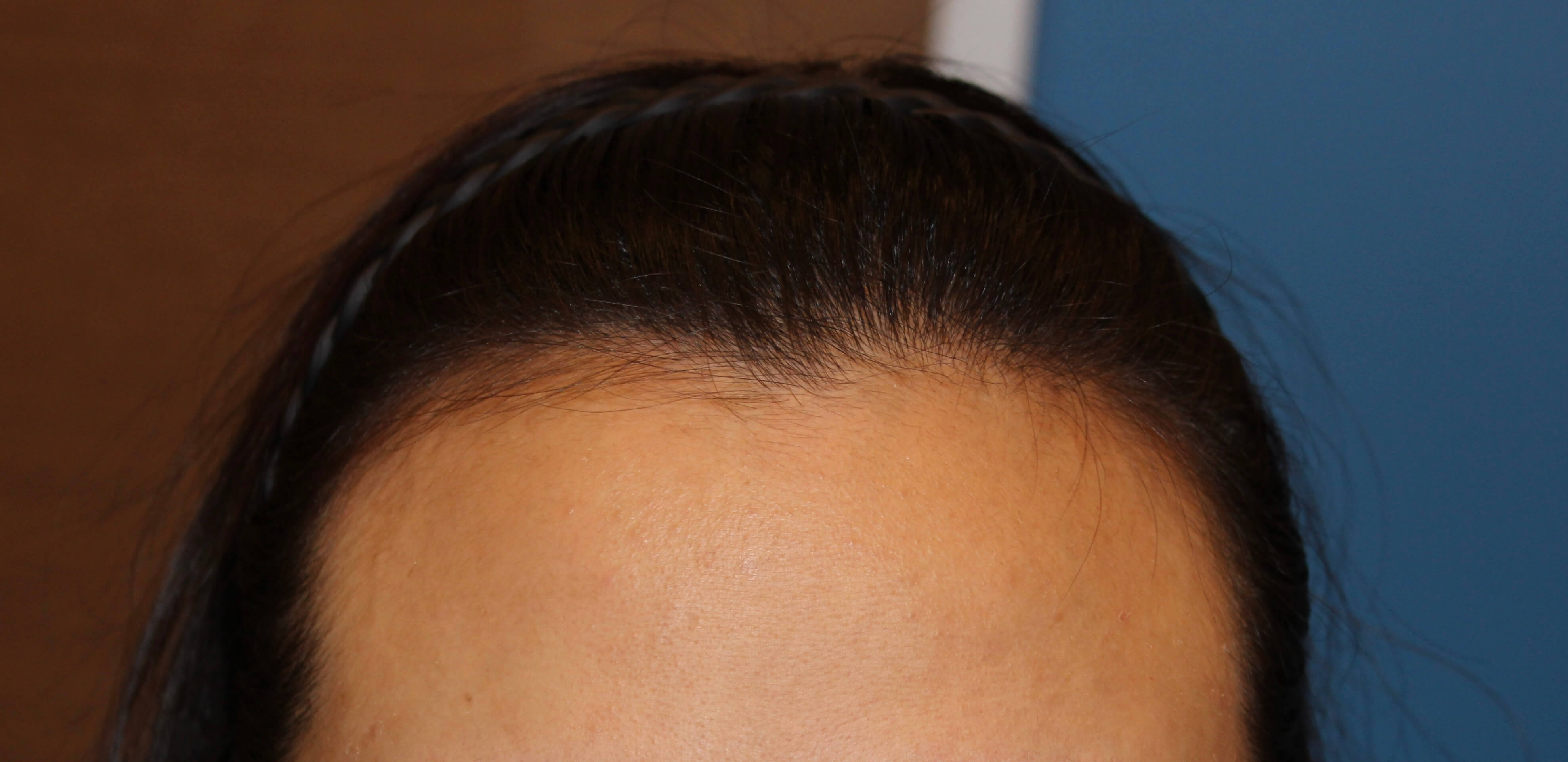 수술 전 M자 이마