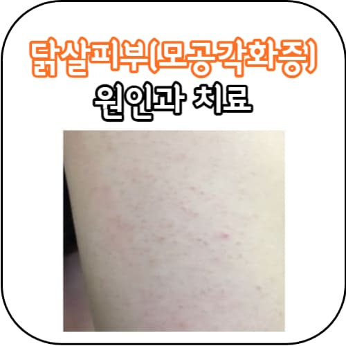 닭살피부-썸네일