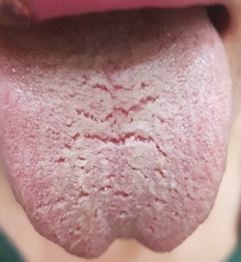 혀 갈라짐 원인