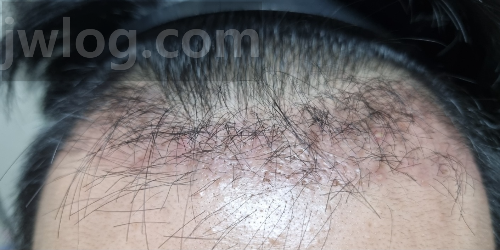 모발이식 45일차