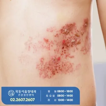경기도 대상포진 무료접종 연령 기준 정리로 안내_21