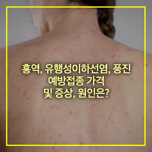 홍역 유행성이하선염 풍진 예방접종 가격 증상 원인