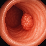 식도암 초기증상