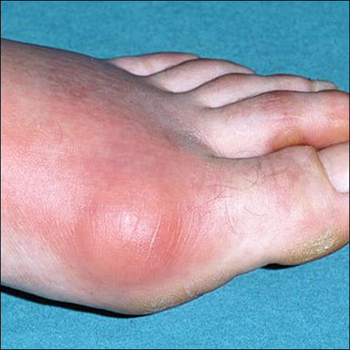 발적이 생긴 왼발