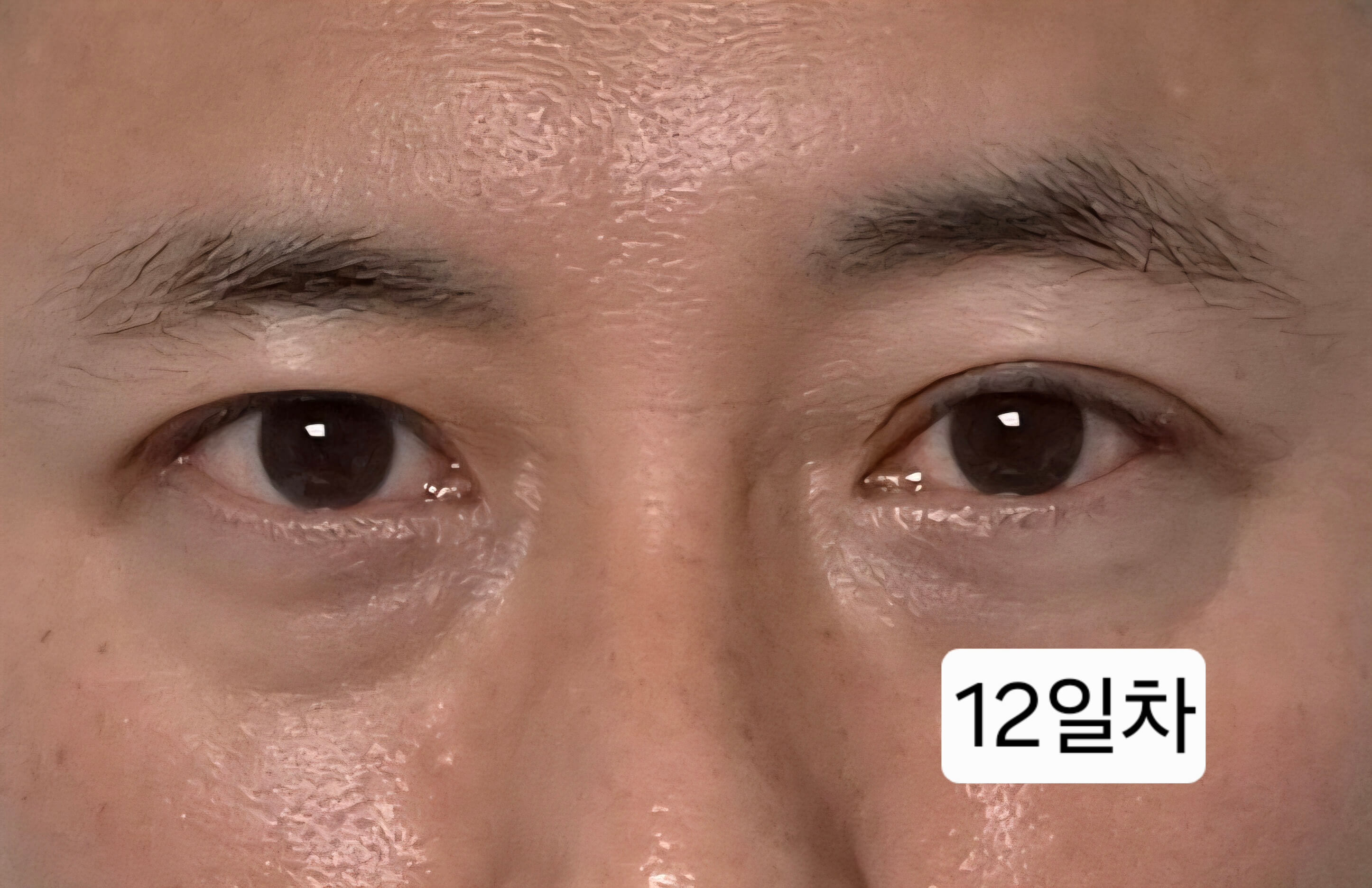 유행성각결막염 눈병 초기증상부터 12일차 치료 기록(진행 중)