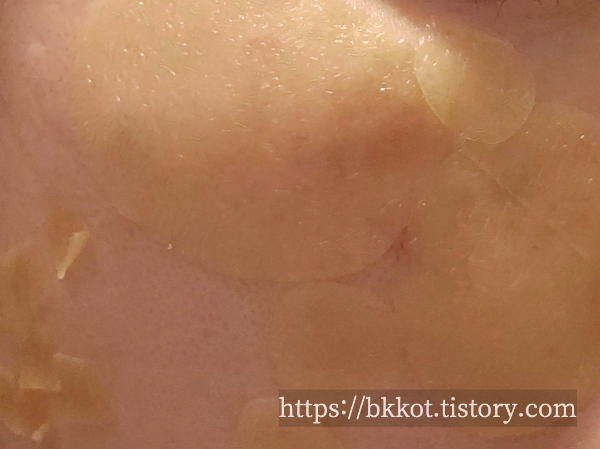 흑자제거 리팟레이저 후기