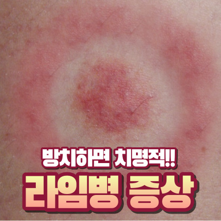 라임병 원인과 증상