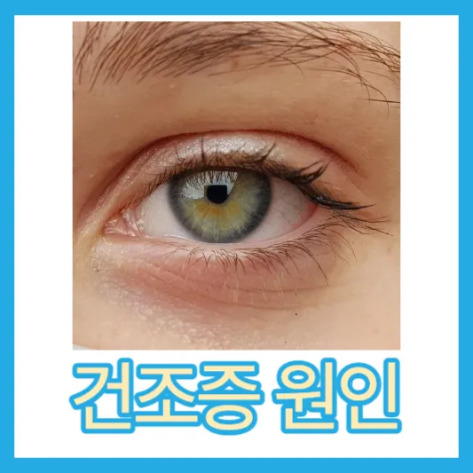 안구건조증 원인