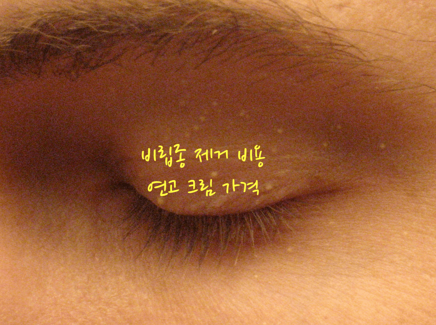 비립종 제거