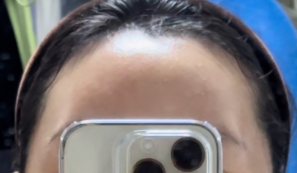 측두근 보톡스